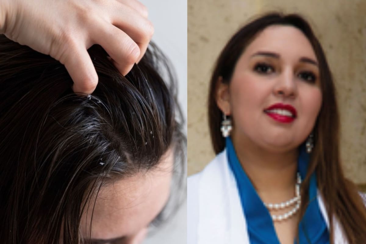 El exceso de grasa afecta el aspecto y la salud del cuero cabelludo