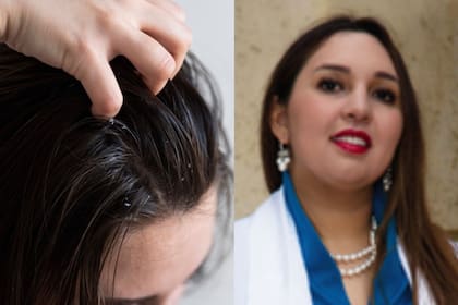 El exceso de grasa afecta el aspecto y la salud del cuero cabelludo