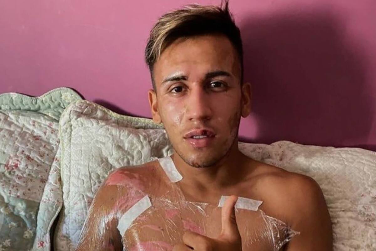 El fubtolista sufrió quemaduras de tercer grado con aceite hirviendo