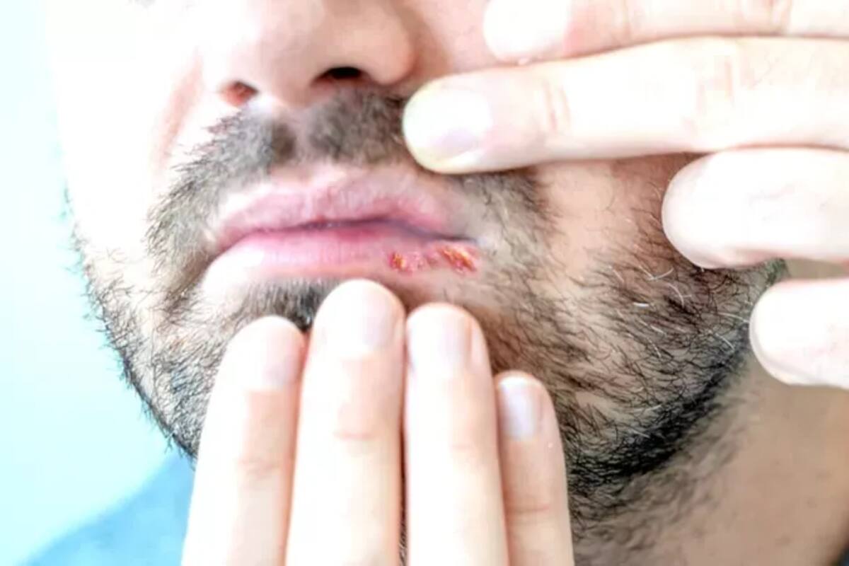 El herpes también puede causar llagas en la boca