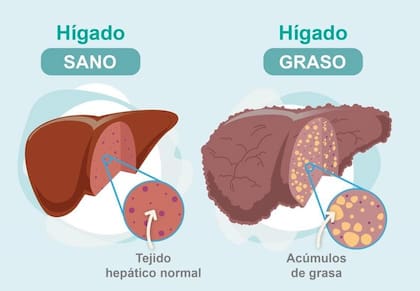 El “hígado graso” supone el depósito excesivo de grasa en el hígado