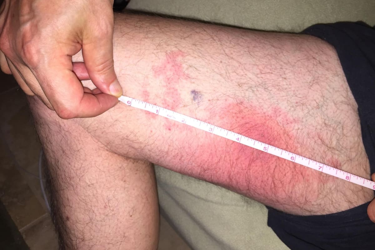 El hombre, de Florida, EE.UU., compartió su experiencia con las temibles hormigas en un grupo de Facebook, para alertar a sus vecinos