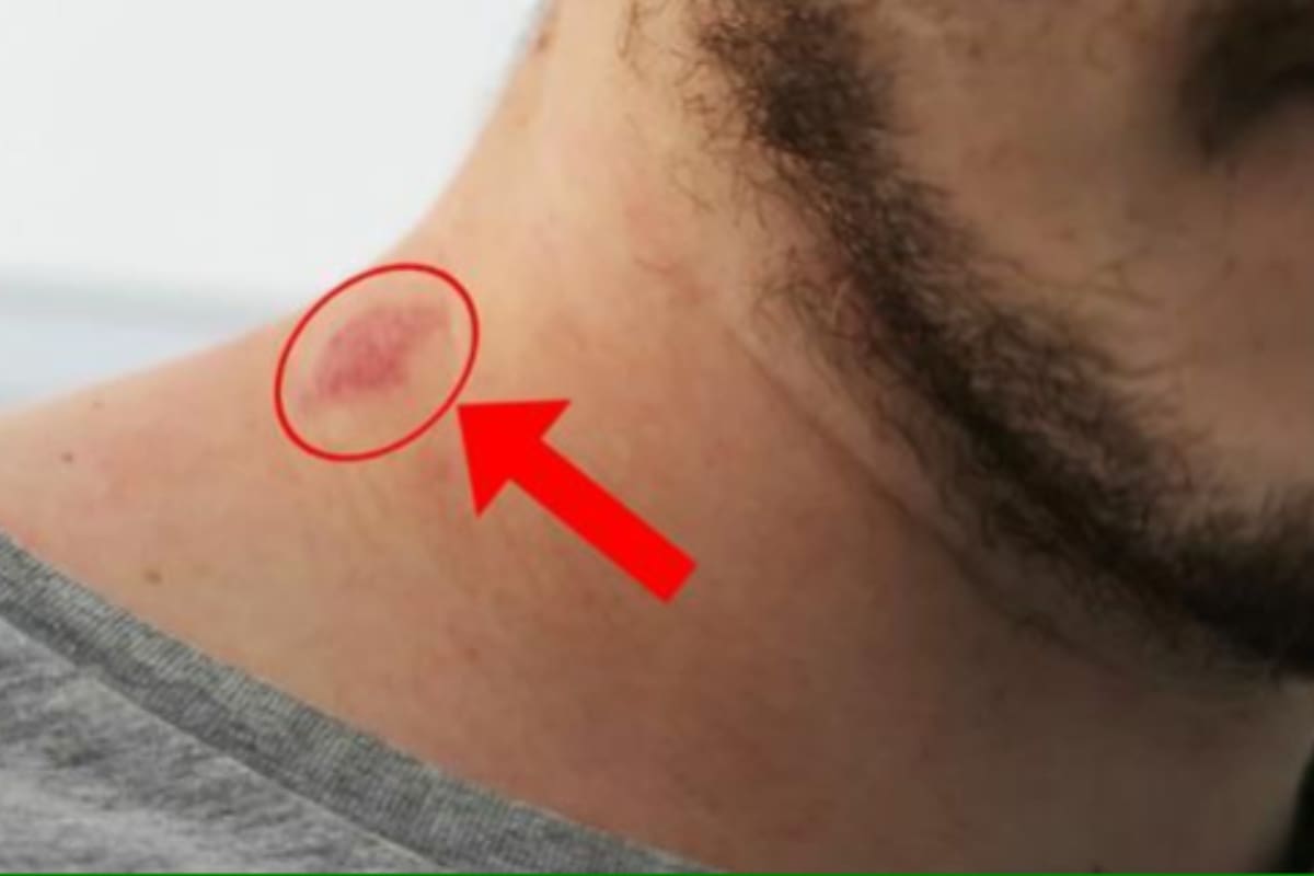 El hombre murió por consecuencia de un chupón (Imagen ilustrativa Ideal)