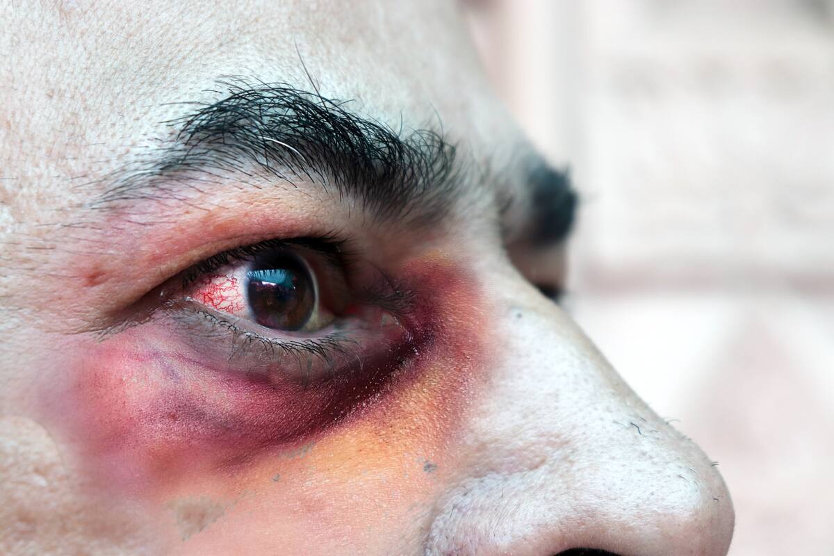El hongo negro afecta las mucosas del ojo