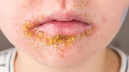 El impétigo se cura con una crema antibiótica