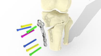 El implante conserva la articulación existente y puede usarse en una etapa más temprana de la artritis, antes de que sea necesario un reemplazo de rodilla