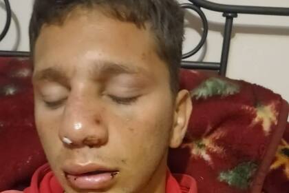 El joven padeció una fractura facial y debió ser hospitalizado