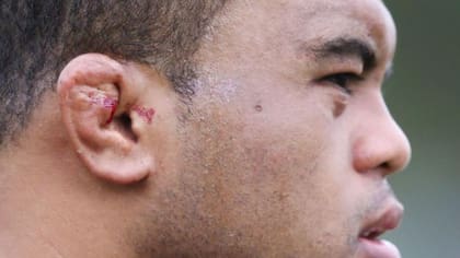 El jugador profesional de rugby Sam Talakai sufría en 2018 de orejas de coliflor sangrantes