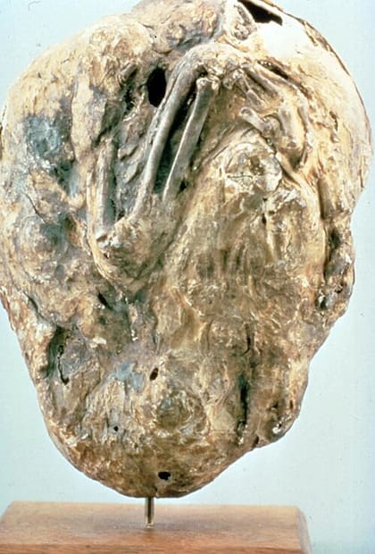 El Litopedion se da por un embarazo ectópico (Foto de un caso médico de Estados Unidos)