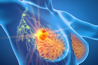 Cáncer de mama: cuándo hay que hacerse la mamografía, si tenés antecedentes familiares