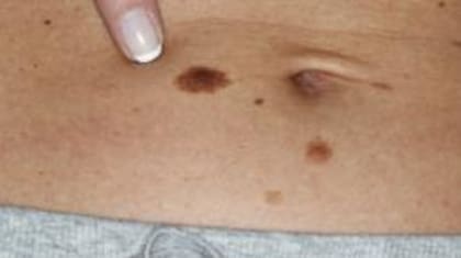 El melanoma se origina en los melanocitos, las células que producen la melanina, el pigmento que da color a la piel
