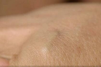 El microchip se coloca debajo de la piel, entre los dedos índice y pulgar