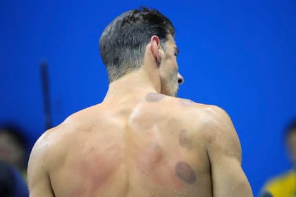 El nadador Michael Phelps fue uno de los primeros que llamó la atención con los círculos en su espalda