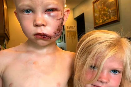 El niño se interpuso entre el perro y su hermana y recibió una mordida en su rostro. Fuente: Instagram