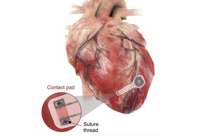 El nuevo modelo de marcapasos temporal no utiliza cables y, gracias a sus componentes no toxicos, se degrada al poco tiempo dentro del cuerpo