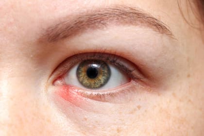 El orzuelo se puede evitar con una buena higiene ocular