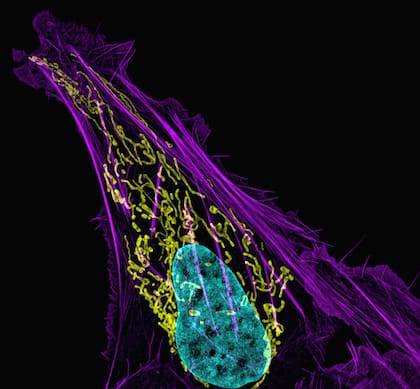 El osteosarcoma es un tipo de cáncer en los huesos