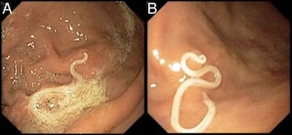 La parasitosis intestinal es una de las más comunes, especialmente en la niñez y la adolescencia, pero también en adultos