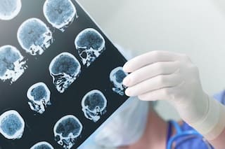 Parkinson: un especialista explicó en detalle cuál es el primer síntoma detectable y el impacto de esta enfermedad en la vida cotidiana