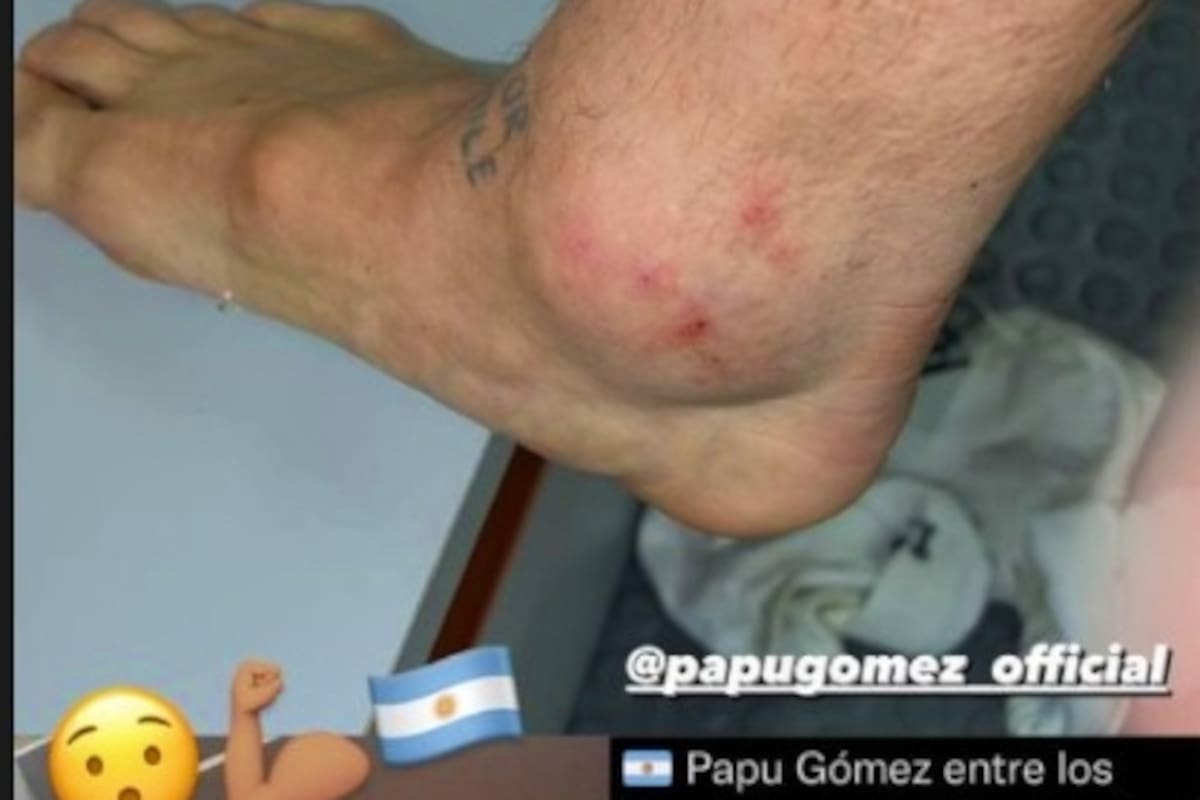 El posteo de Instagram en el que se ve cómo quedó el tobillo de Alejandro "Papu" Gómez tras el partido con Chile por la eliminatoria para Qatar 2022.