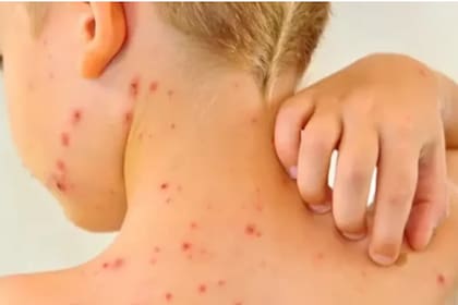 El sarampión es una enfermedad viral altamente contagiosa
