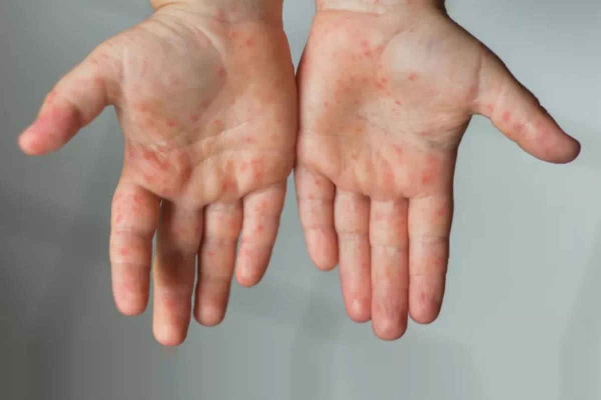 El sarampión es una enfermedad viral altamente contagiosa