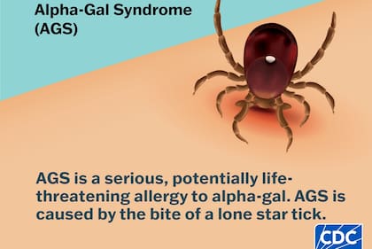 El síndrome alfa-gal (SAG) es una alergia grave que puede desencadenarse tras comer carne roja