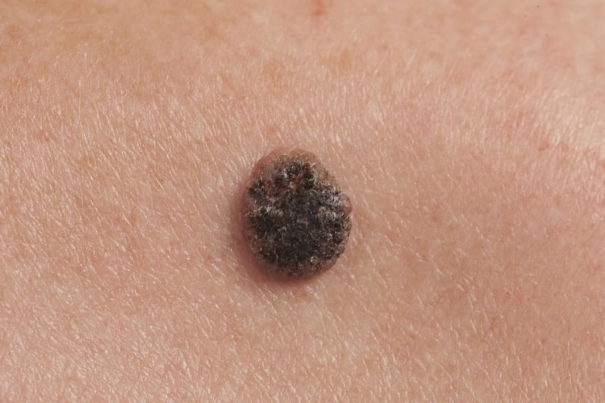 El síntoma más común del melanoma es la aparición de un nuevo lunar o la presencia de cambios en uno ya existente.