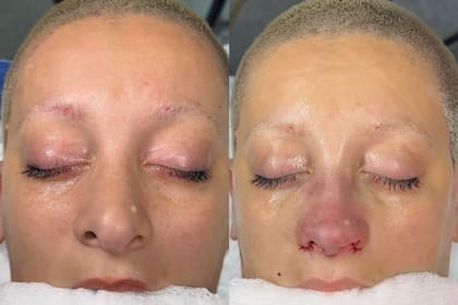 El sorprendente antes y después de Furia tras su rinoplastia (Captura: Instagram @furiascaglione)