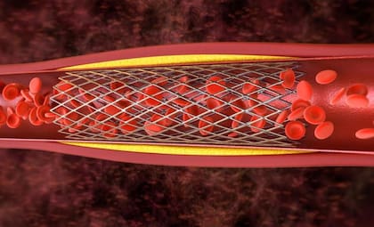 El stent es un tubo de malla abierta que, una vez insertado, expande el vaso sanguíneo, manteniéndolo abierto para restablecer el flujo sanguíneo normal