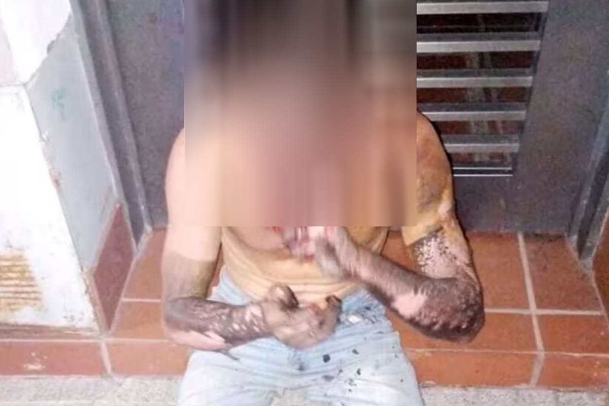 El sujeto de 24 años sufrió quemaduras en el 50% de su cuerpo tras intentar robar cables de alta tensión en Rosario