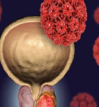 El tacto rectal, clave en el diagnóstico temprano