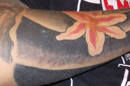Las lesiones se observan en la parte inferior del tatuaje de una flor de loto, en el brazo derecho de Roberto Ortiz