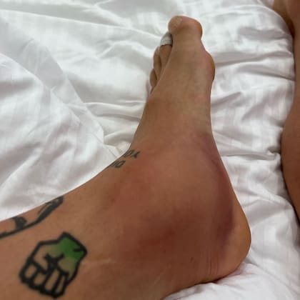 El tobillo inflamado de Alejandro Gómez tras el partido con Australia
Foto: INSTAGRAM / @papugomez_official