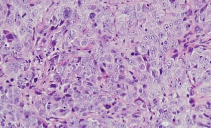 El trastorno aumenta el riesgo de desarrollar diabetes tipo 2 y problemas cardiovasculares