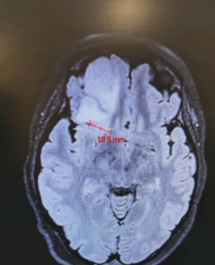 El tumor tenía 6 centímetros de grosor