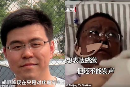 El urólogo Hu Weifeng antes (izquierda) y después (derecha) del tratamiento que recibió por COVID-19