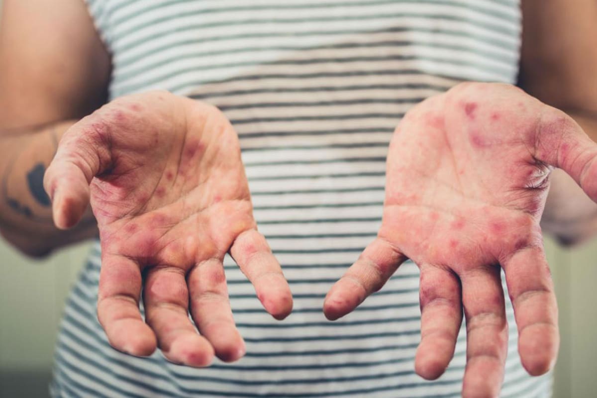 El virus con más capacidad de diseminación es el sarampión. Crédito: Carmeloportal