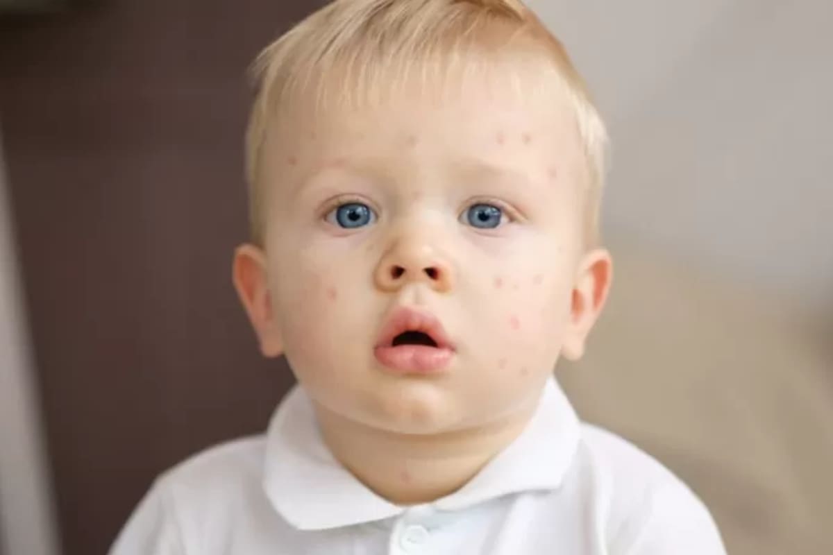 El virus del sarampión fue controlado en muchos países gracias a la vacuna