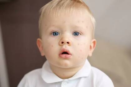 El virus del sarampión fue controlado en muchos países gracias a la vacuna