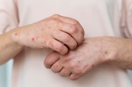 El virus es altamente contagioso, se transmite por aire y causa fiebre, tos y sarpullido