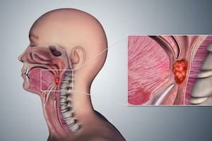 El VPH se transmite por vía sexual, en el caso del cáncer orofaríngeo, el principal factor de riesgo es el número de parejas sexuales a lo largo de la vida, especialmente por la práctica de sexo oral