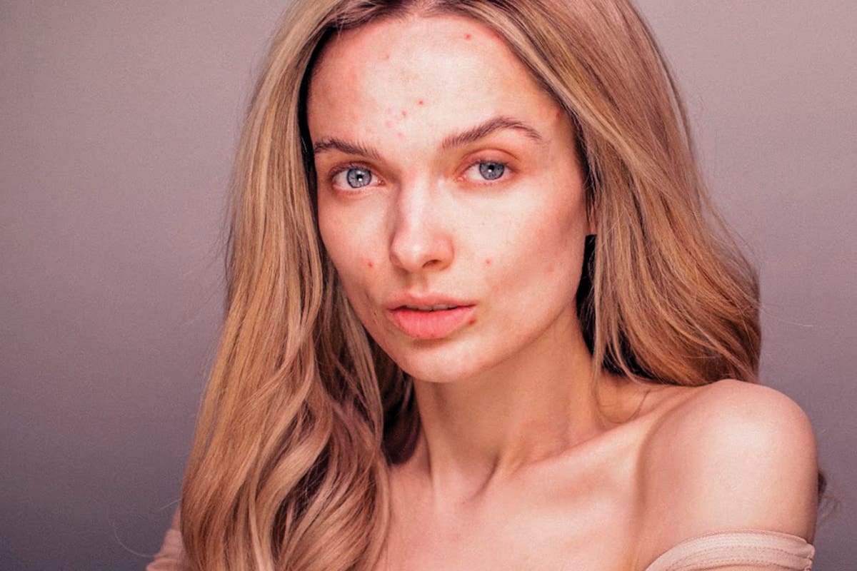 Em Ford es una bloguera de belleza y considerada la gran precursora del movimiento skin positive.