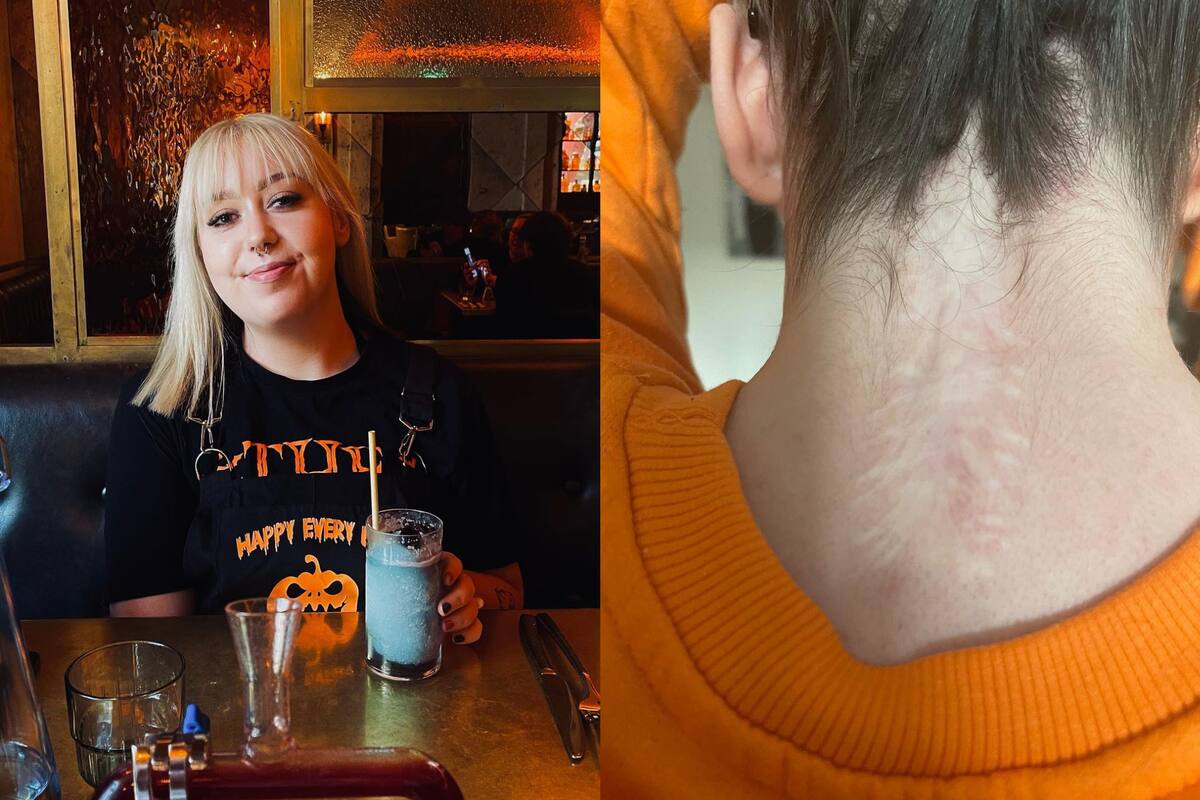 Emily se sometió a dos cirugías de columna.