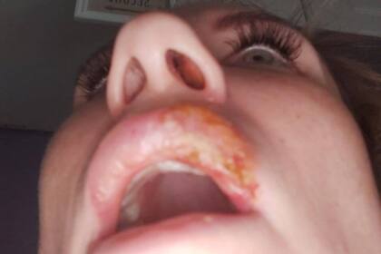 Emma Palmer sufrió un calvario que ya lleva más de dos años, desde que se aplicó una dosis de relleno labial en octubre de 2018