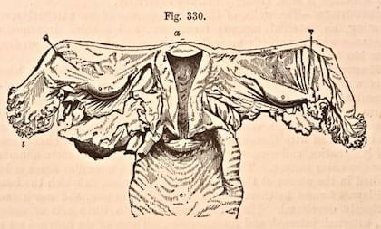 En 1876, de cuando data este grabado, se tenía un poco más clara la anatomía de un útero y ya se sabía que no vagaba por el cuerpo.