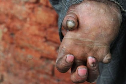 En 2019 se detectaron un total de 202.185 nuevos casos de la enfermedad en 120 países del mundo.