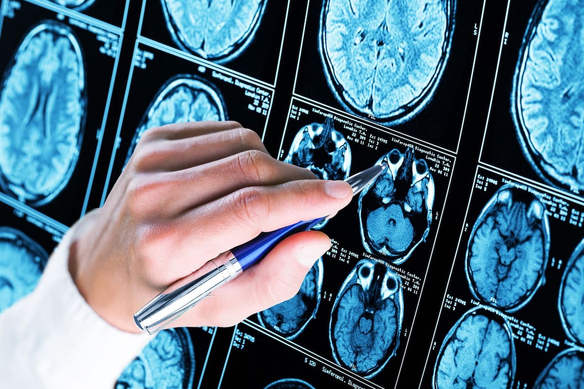 En el estudio publicado hoy, observaron una reducción generalizada de la materia gris y del volumen y el grosor de la corteza cerebral desde la novena semana del embarazo