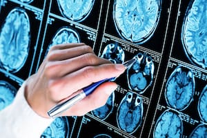 En el estudio publicado hoy, observaron una reducción generalizada de la materia gris y del volumen y el grosor de la corteza cerebral desde la novena semana del embarazo