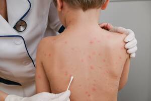 En el país, la cobertura con la vacuna triple viral está por debajo del 95% que se requiere para lograr un nivel de protección de la población